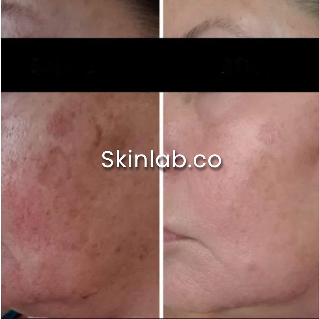 SkinLab Stem Cell Microneedling Solution